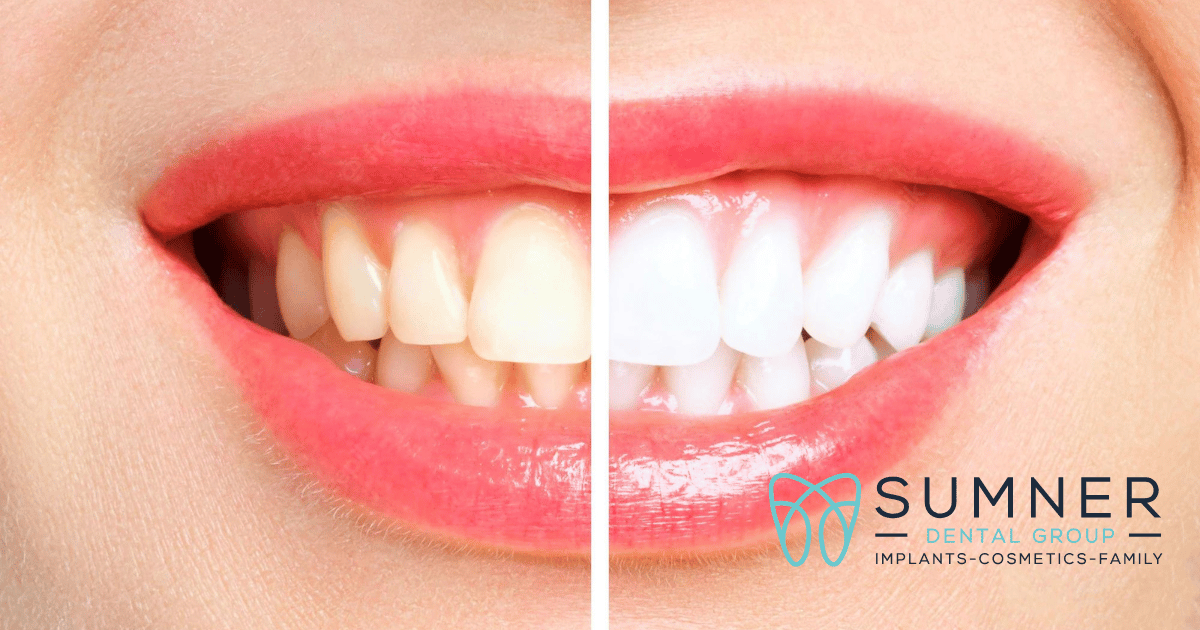 cosmetic dentistry, cosmetic dentist, teeth whitening in Gallatin