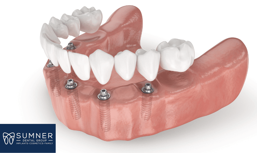 Dental Implants in Gallatin