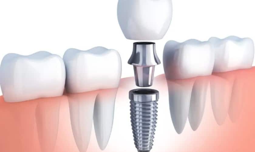How To Care For Your Dental Implants Tips And Tricks
