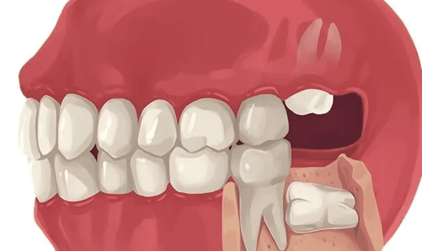 Importance of Wisdom Teeth Removal