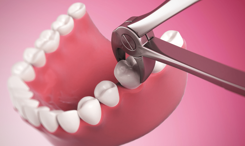 What Happens To The Stitches After Wisdom Tooth Extraction